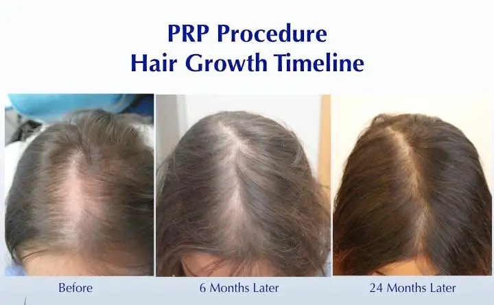 How Long Does PRP Take to Work for Hair Loss?