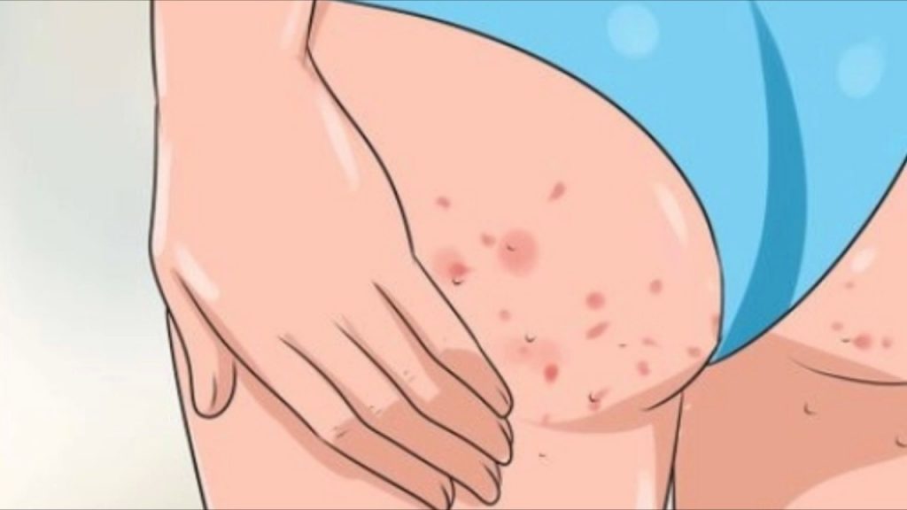 How to Get Rid of Rashes on Buttocks?