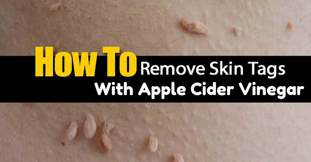 What Does Apple Cider Vinegar do to Skin Tags?