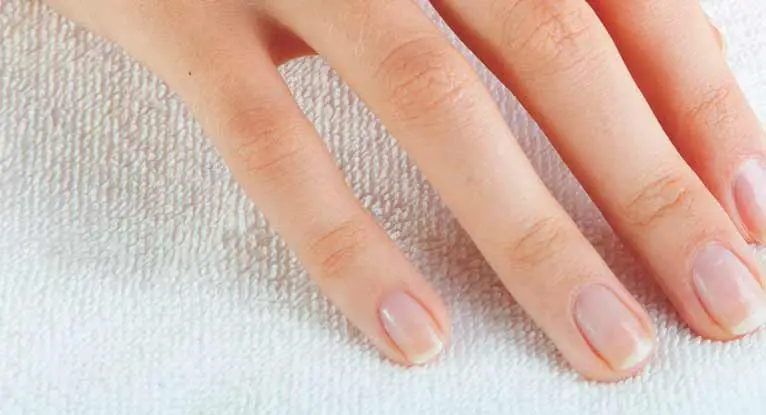 What Vitamin Deficiency Causes Nails to Peel?