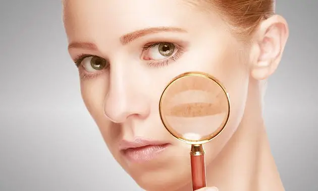 How to Cure Melasma from the inside?