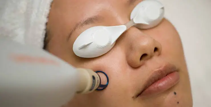 How to Take Care of Face after Laser Treatment?