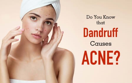Can Dandruff Cause Acne on Cheeks? Real facts by Dr. Abraiz