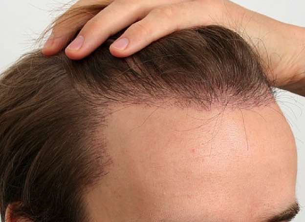 Is Microneedling Good for Hair Growth?