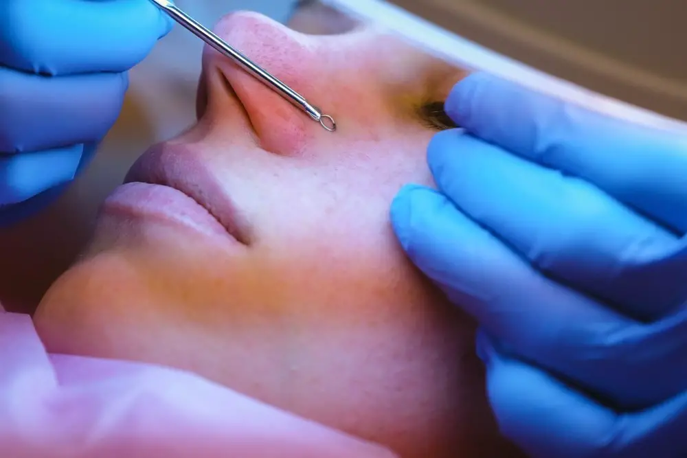 How Do Dermatologists Remove Blackheads? 7 Best Methods