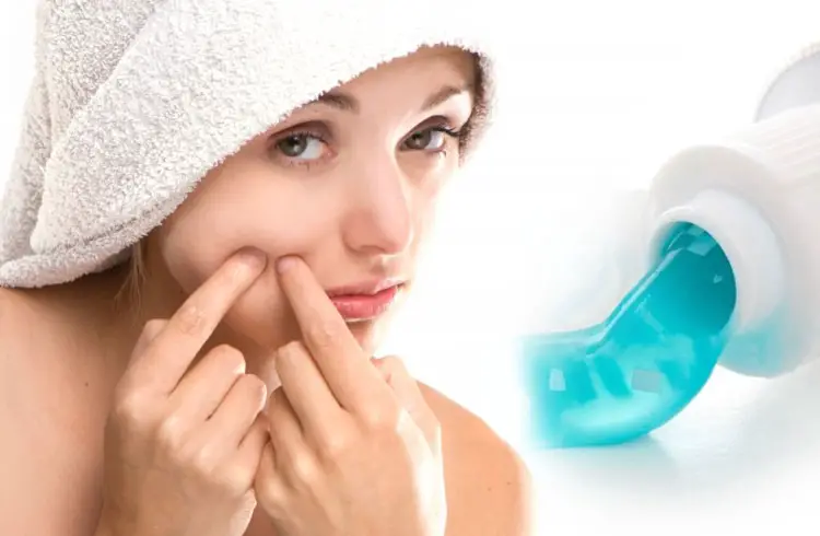 How to get rid of blackheads overnight with Toothpaste?