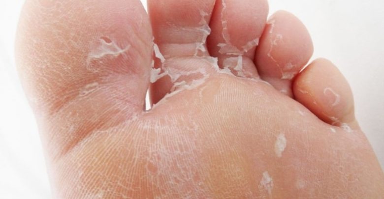 what-causes-skin-peeling-on-bottom-of-feet-real-facts