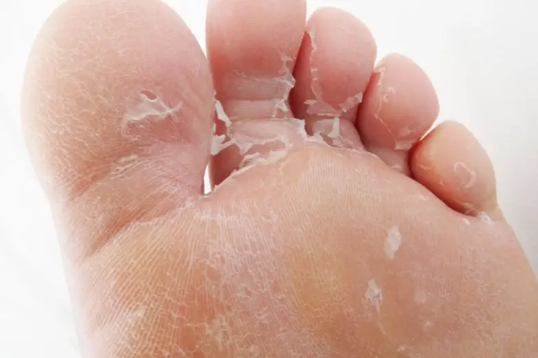 What causes skin peeling on bottom of feet?