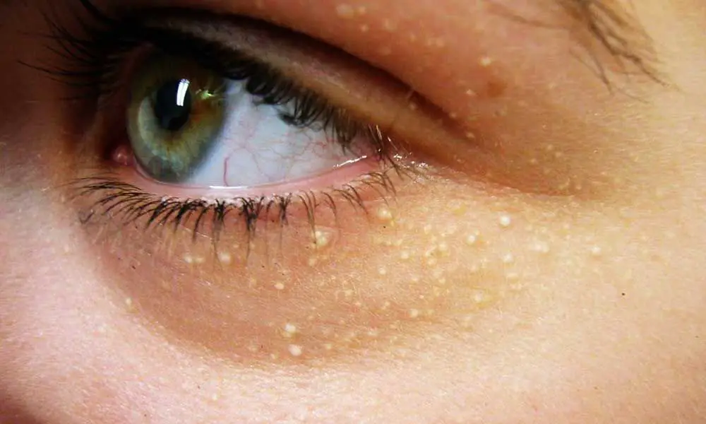 How to cover cholesterol spots on eyes with makeup?