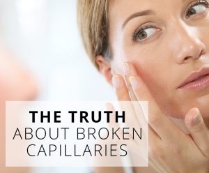 What causes broken facial capillaries? Real Facts