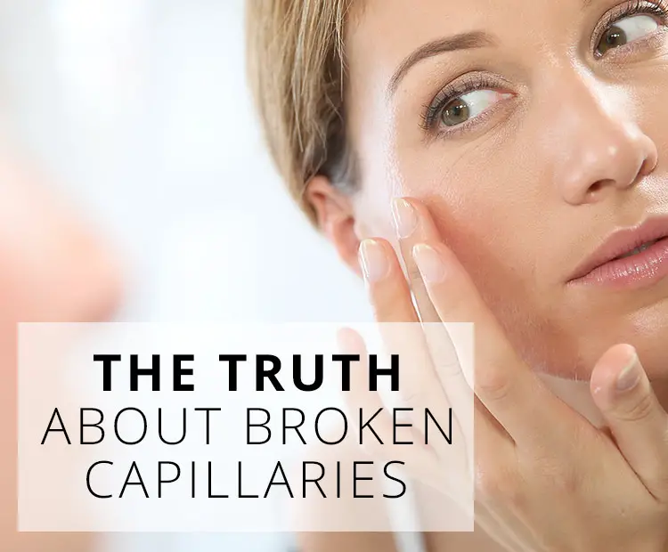 What causes broken facial capillaries?
